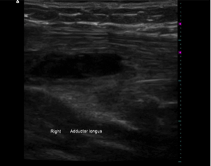 Ultrasound of Adductor Longus