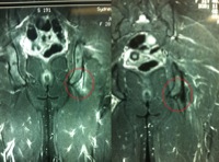 lightbox - MRI pre and post PRP