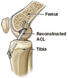 ACL Reconstruction