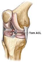 Torn ACL