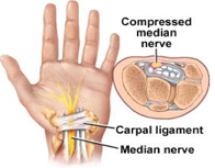 Carpal Tunnel Diagram