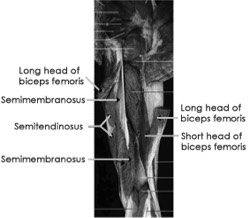 Hamstring Injuries